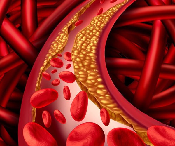 What high cholesterol can do to the body