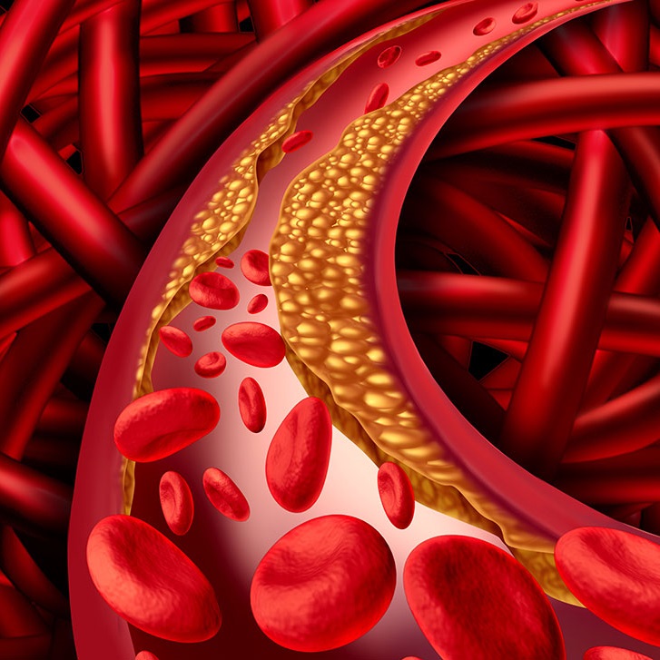 What high cholesterol can do to the body