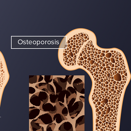 Symptoms of Osteoporosis